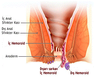 Hemoroid Nedir